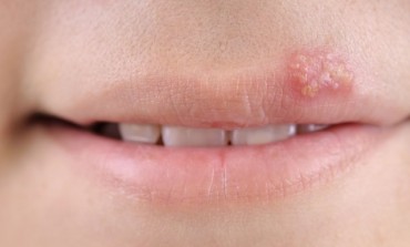 Herpes: Tri savjeta za spriječavanje ranica oko usana